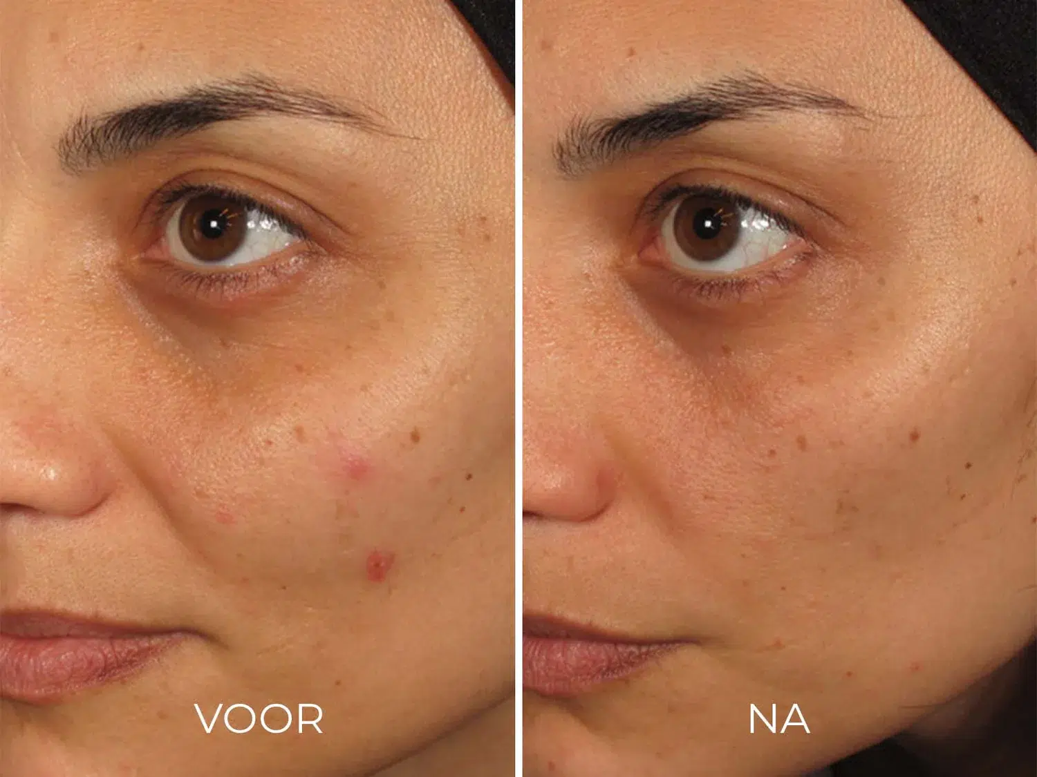 ILUMA - Intense Facial Illuminator - Afbeelding 5