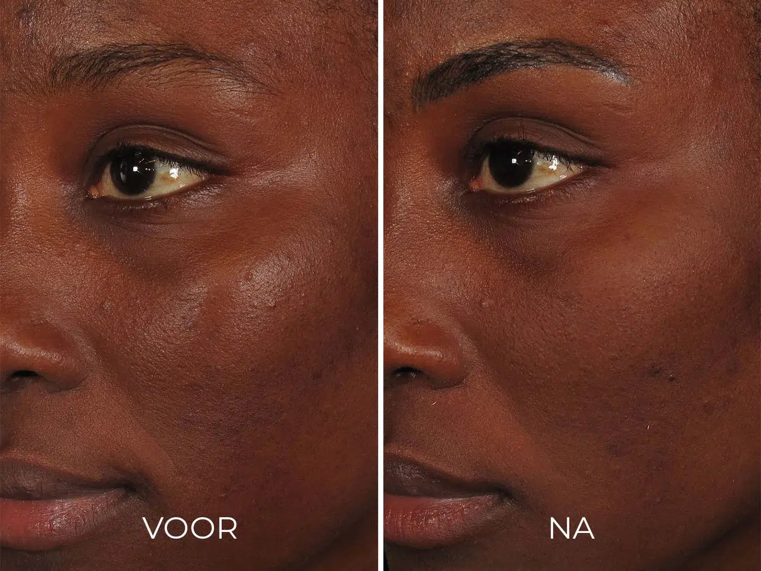 ILUMA - Intense Facial Illuminator - Afbeelding 4